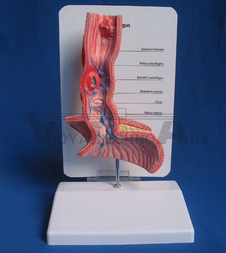 Pathologic oesophagus model